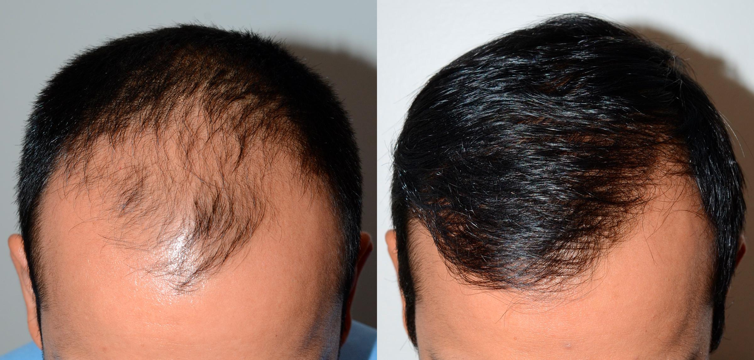 Hair Transplant in London: What You Need to Know Before Going Under the Knife